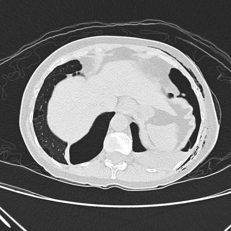 Non-contrast CT thorax